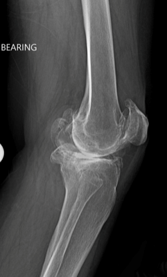 X-ray image of a knee joint prior to knee replacement surgery.