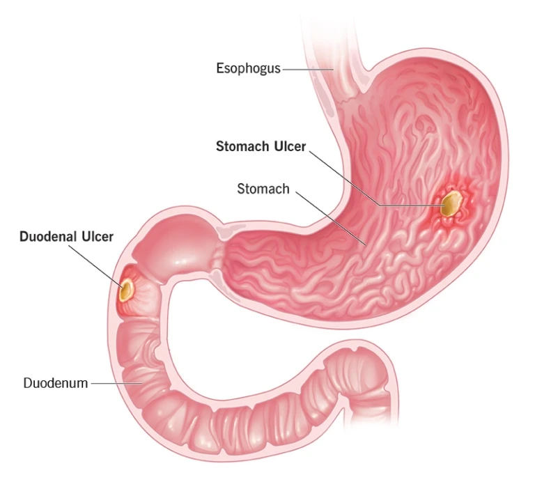 An illustration of the stomach and duodenum, identifying where ulcers can form in the digestive system. Image text reads: 'Esophagus' 'Stomach Ulcer' 'Stomach' 'Duodenal Ulcer' 'Duodenum'