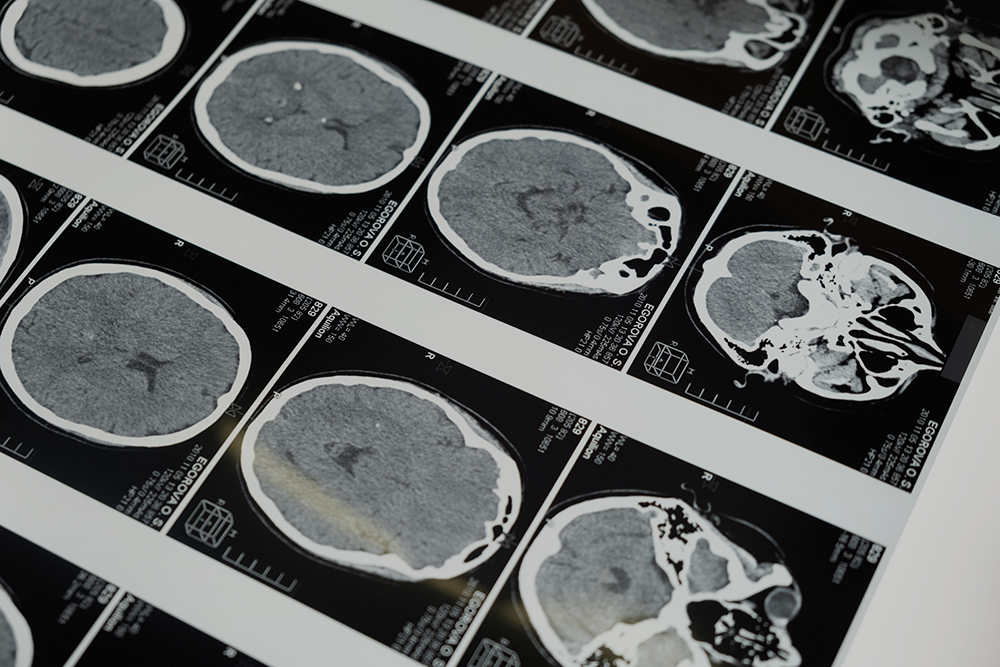 A series of black and white medical scans of the brain.