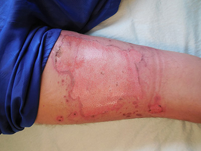 Kent Long suffered 1st to 3rd degree burns on the back of his thighs due to fireworks injury.