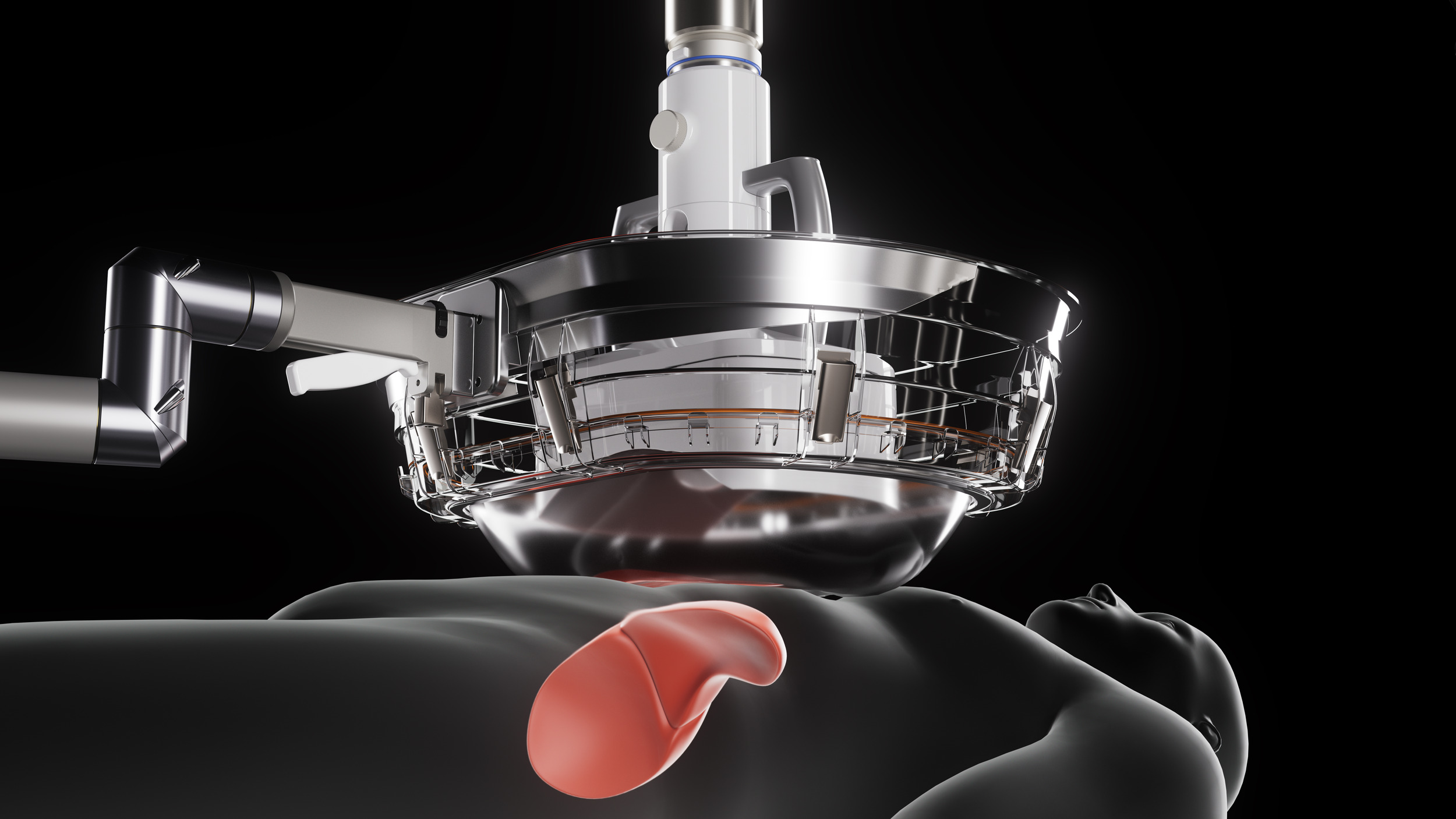 Animation rendering: Edison system with patient coupling kit shows use of Histotripsy to target liver tumors; Courtesy: HistoSonics®, Edison® System Histotripsy Program.