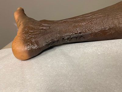 A close-up of Mahntie's scar from ankle surgery.