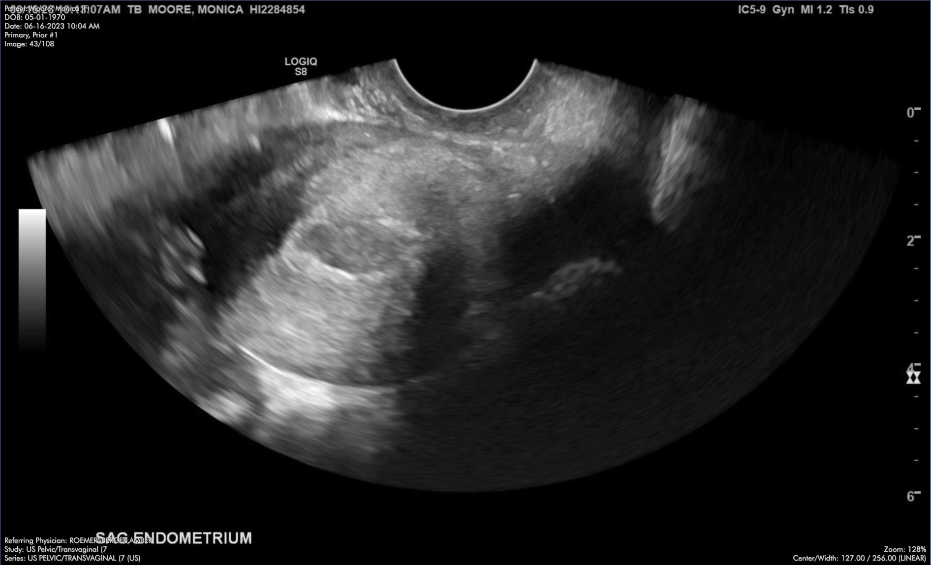 Ultrasound of Monica's tumor