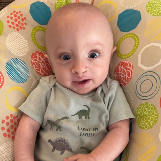 Obadiah Freeman smiles after having cleft palate surgery.