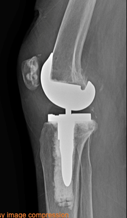 X-ray image of a knee joint after knee replacement surgery.