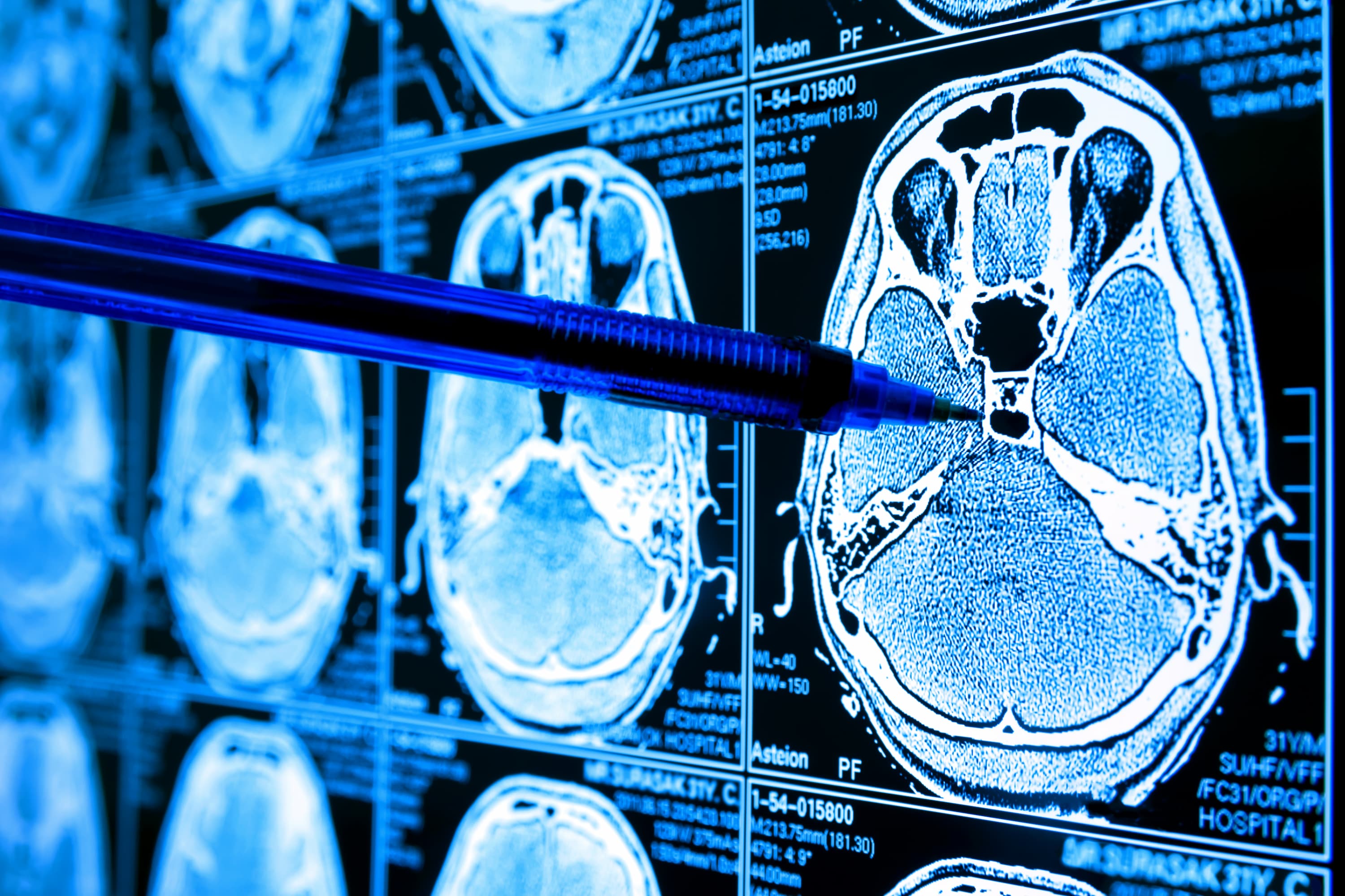 A doctor points a pen to an image in an AI biomedical algorithm screen and machine learning used to detect brain cancer cells.