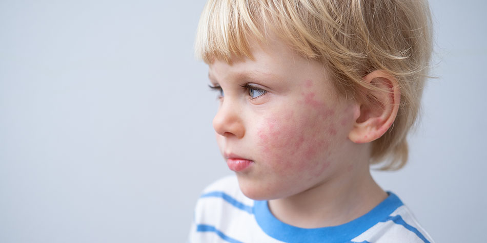 Young boy with facial rash