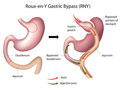 Roux-en-Y Gastric Bypass (RNY) diagram.