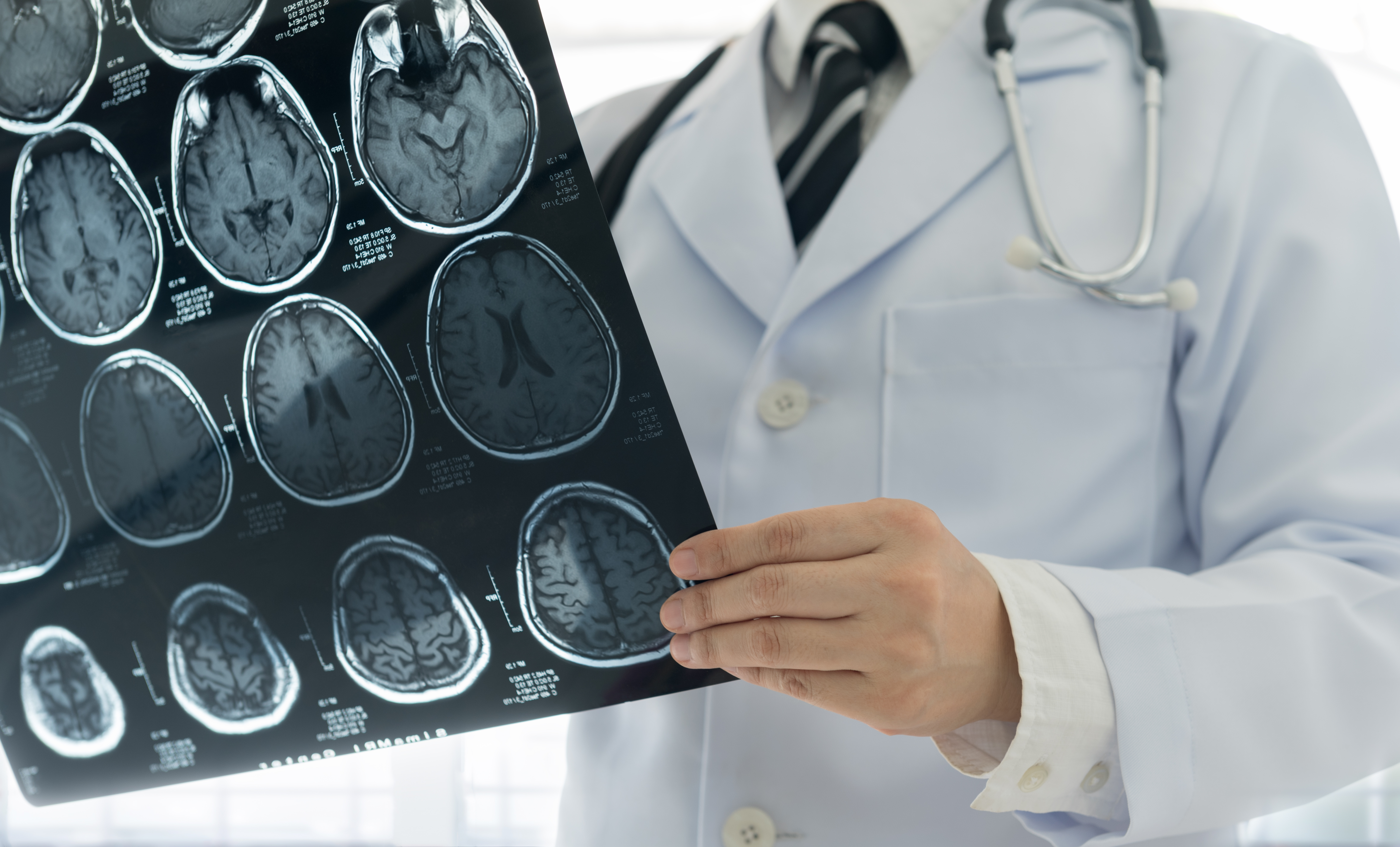 Doctor holding brain MRI results.