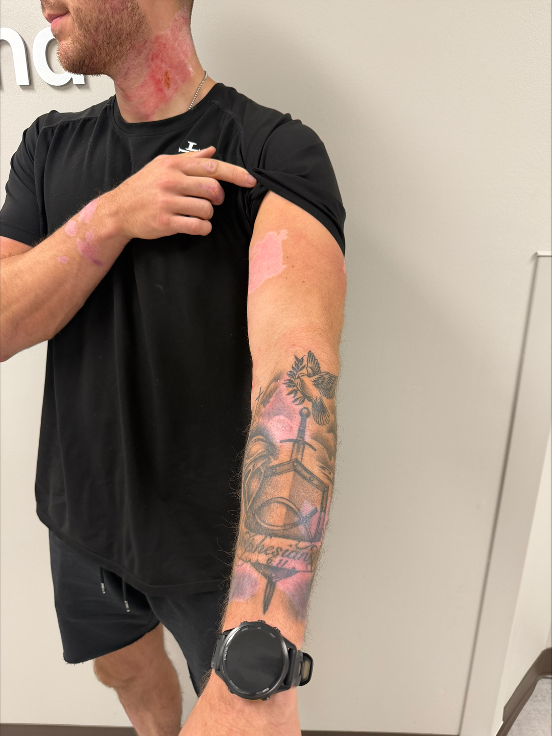 Malcolm Dile showing the results of his care at TriStar Skyline.