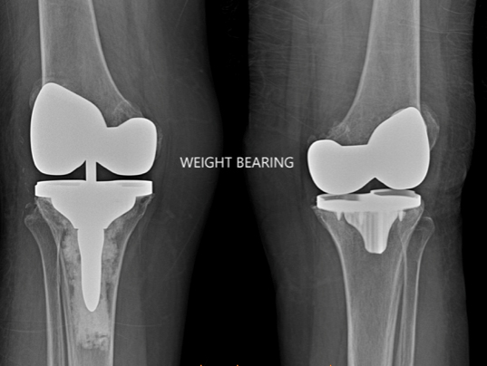 X-ray images of Trudy's knee replacement surgery, showing the weight bearing portions of the replacement.
