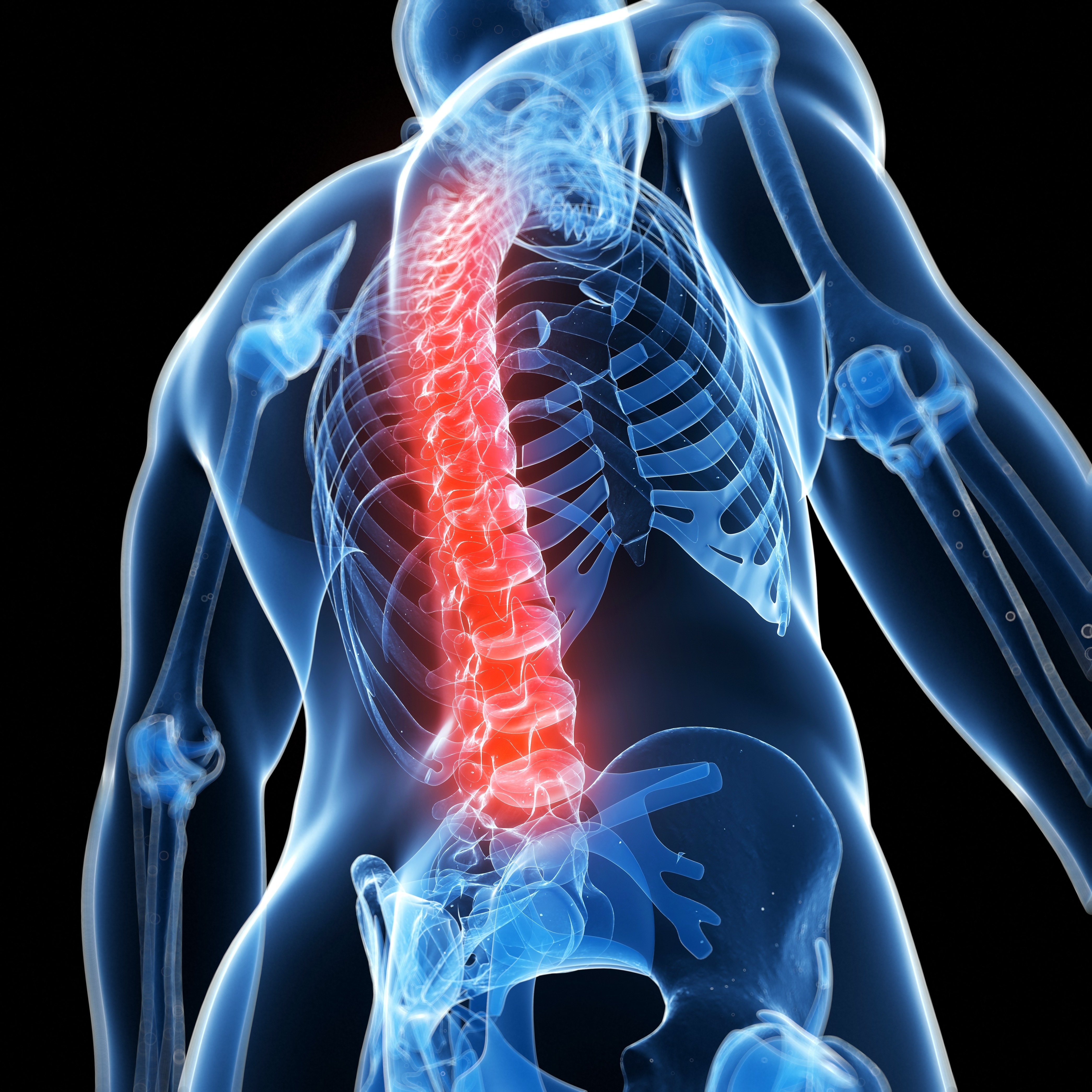 3 D diagram of a back, highlighting the base of the spine towards to the top.