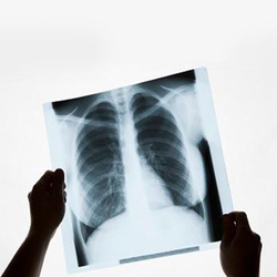 A person holds a chest x-ray to a screen