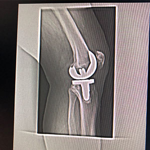 An x-ray image of William Thompson's knee.