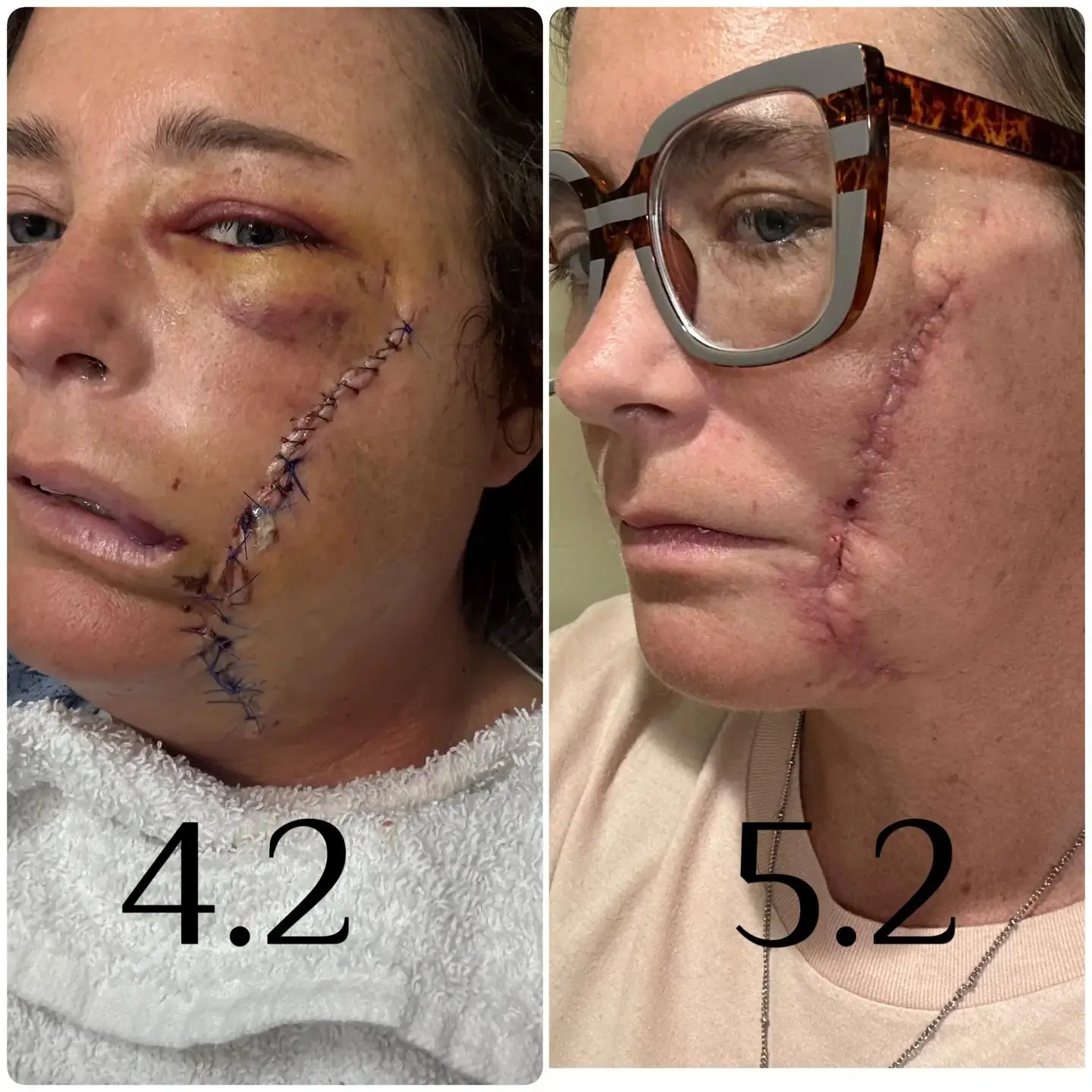 Lindsey Crouch before and after face scar photos with "4.2" on left and "5.2" on right; showing improvement in her trauma to her face