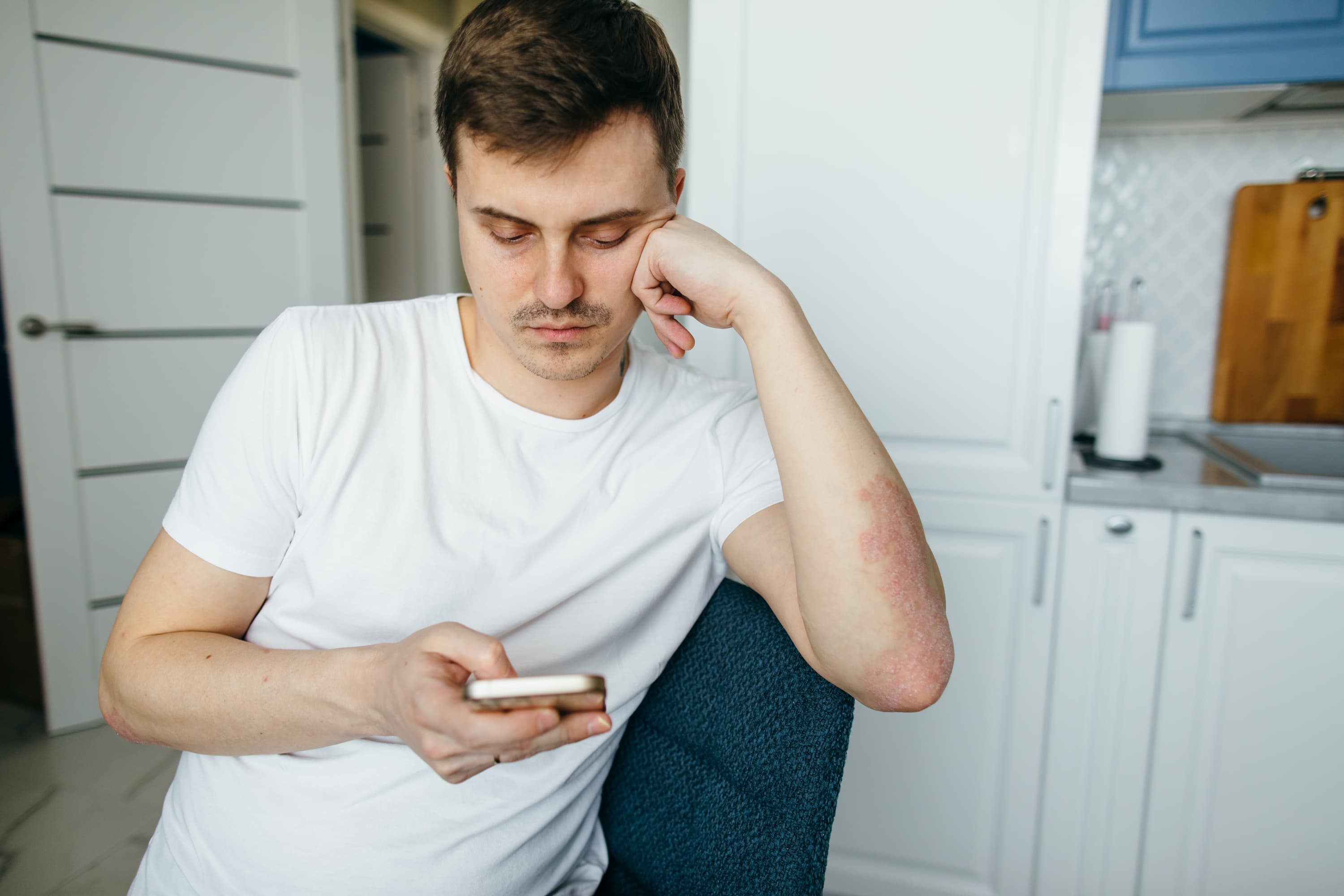 A young man with a psoriasis rash on his arm looks at his phone while seated in a chair.