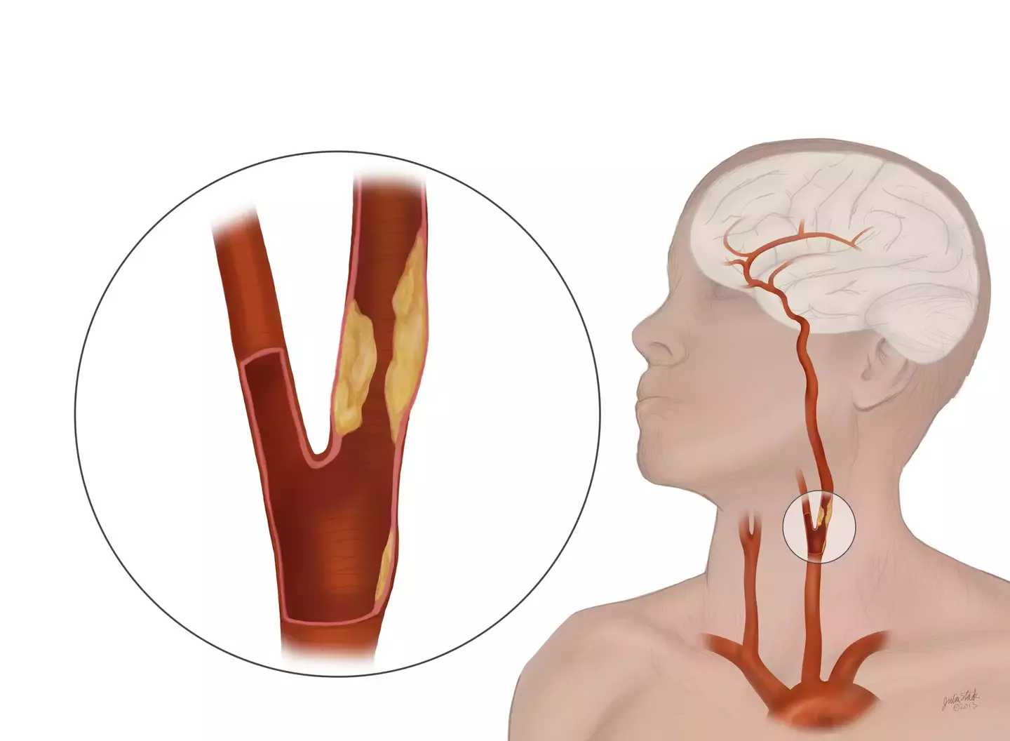 Carotid artery disease is a build-up of plaque in one or both of the neck's main arteries, causing them to narrow and slow down blood flow, potentially causing a stroke if blood flow stops or plaque fragments travel to the brain.