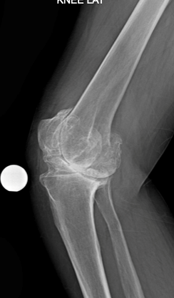 X-ray image of a knee joint prior to knee replacement surgery.