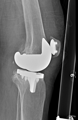 X-ray image of a knee joint after knee replacement surgery.