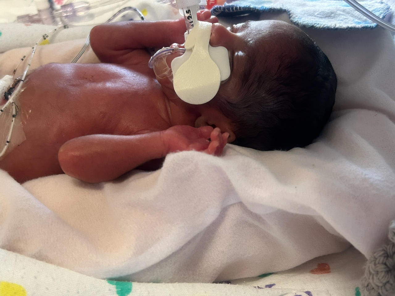Phillip lays in NICU bed