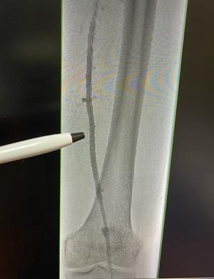 Patient, Roy, right leg post angiogram procedure.