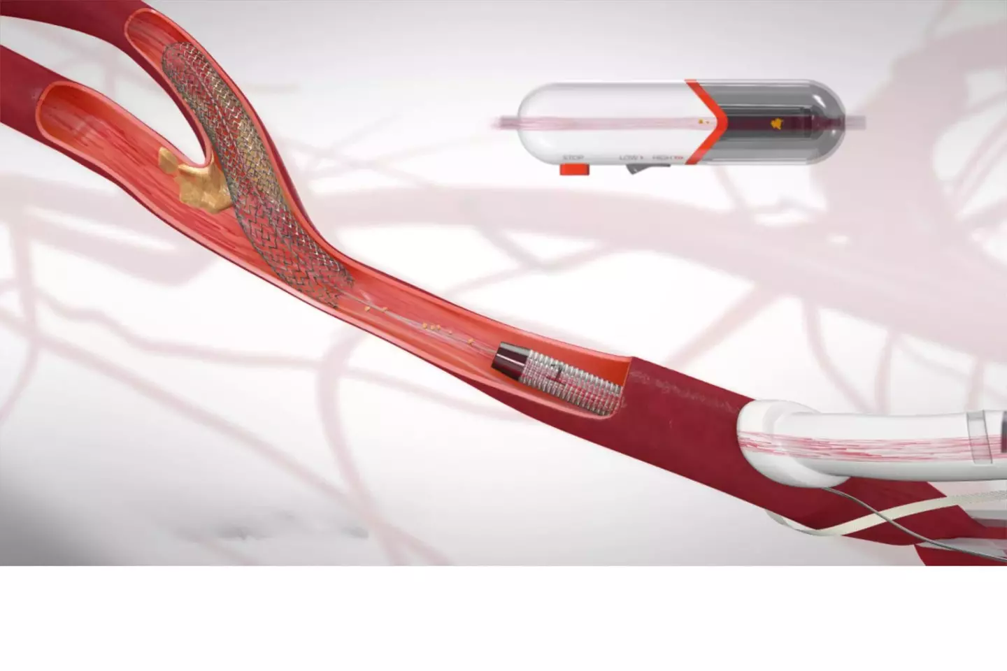 The TCAR procedure temporarily reverses the blood flow so that any small bits of plaque that may break off during the procedure are diverted away from the brain, preventing a stroke from happening. A stent is then placed inside the artery to stabilize the plaque, minimizing the risk of a future stroke.