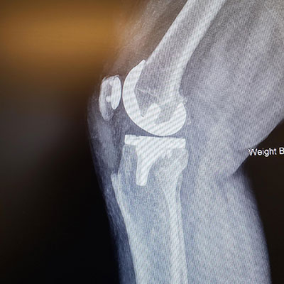 X-ray image of patient's knee.
