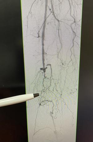 Patient, Roy, right leg before angiogram procedure.