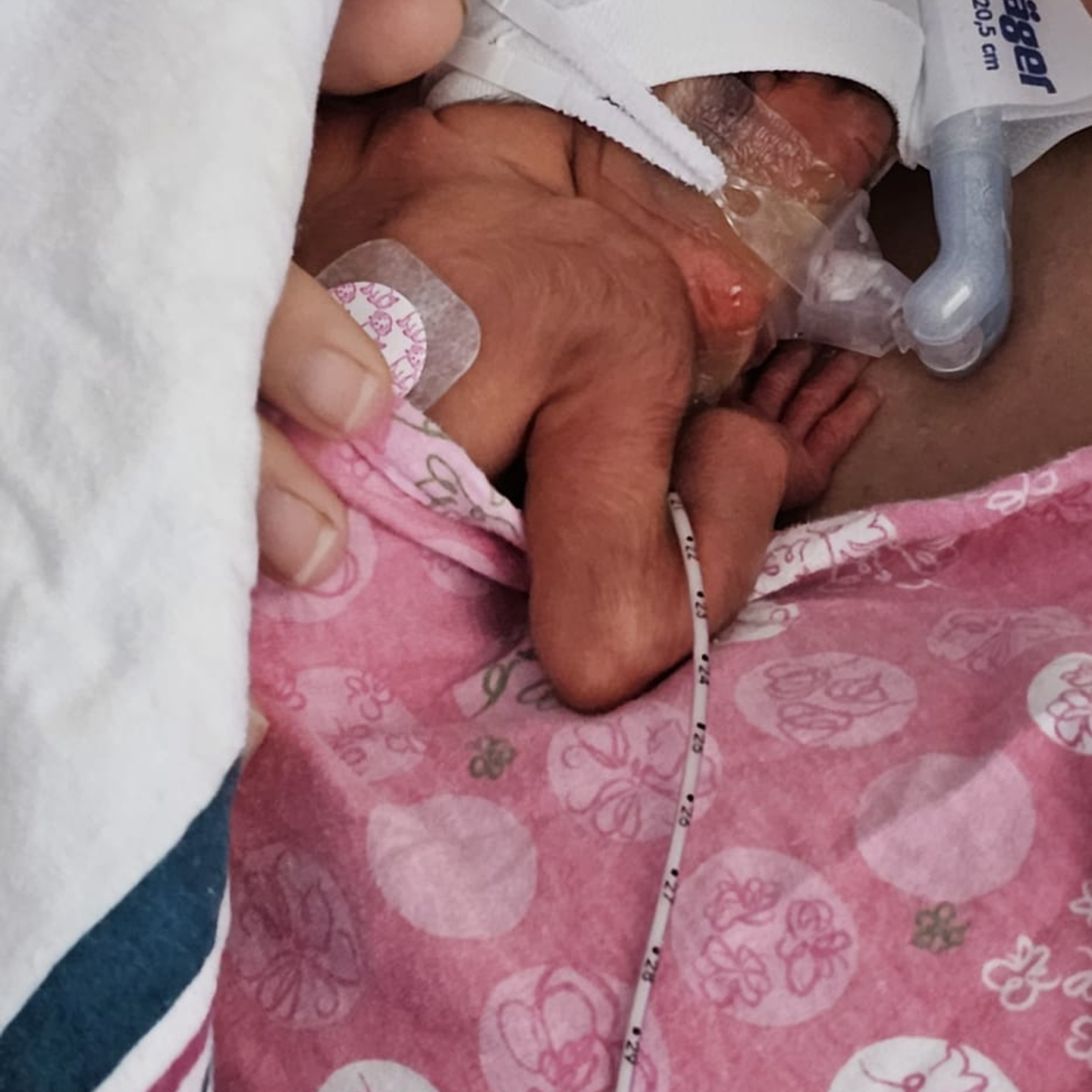 Premature baby, Mia Ramirez, wearing breathing mask, being held by her mother Gloria.