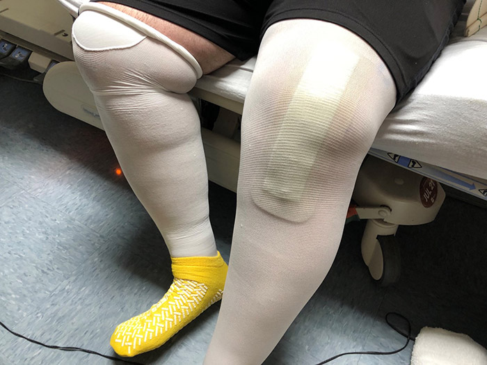 Rolando's knees in braces.