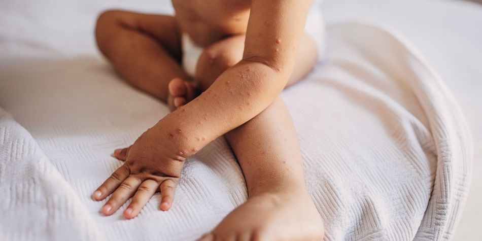 A baby with hand, foot, and mouth infection skin rash sits on a bed.