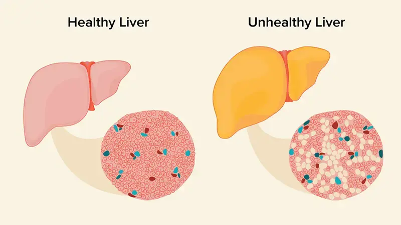 An illustration of a healthy and unhealth liver, showing the differences in fat distribution within the cells.